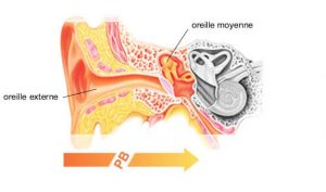 perte auditive de transmission