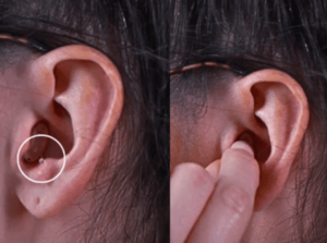 retirer un appareil auditif intra auriculaire